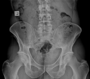 Gonstead pelvis xray