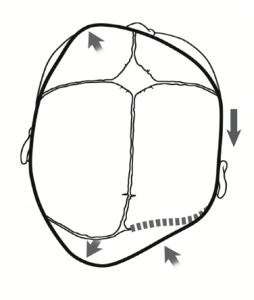 Synostotic plagiocephaly
