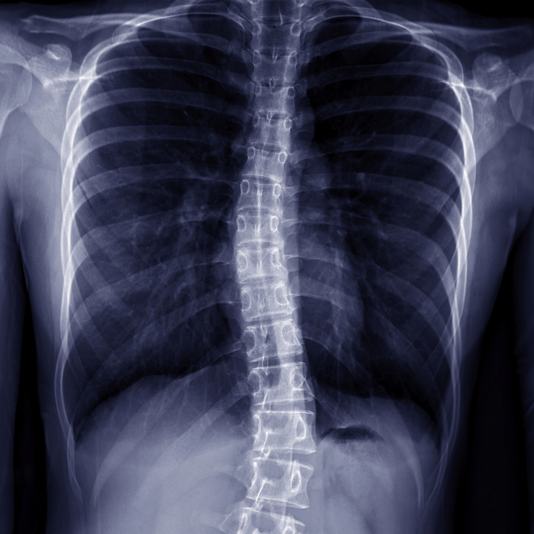 A_Scoliosis-Awareness-Month