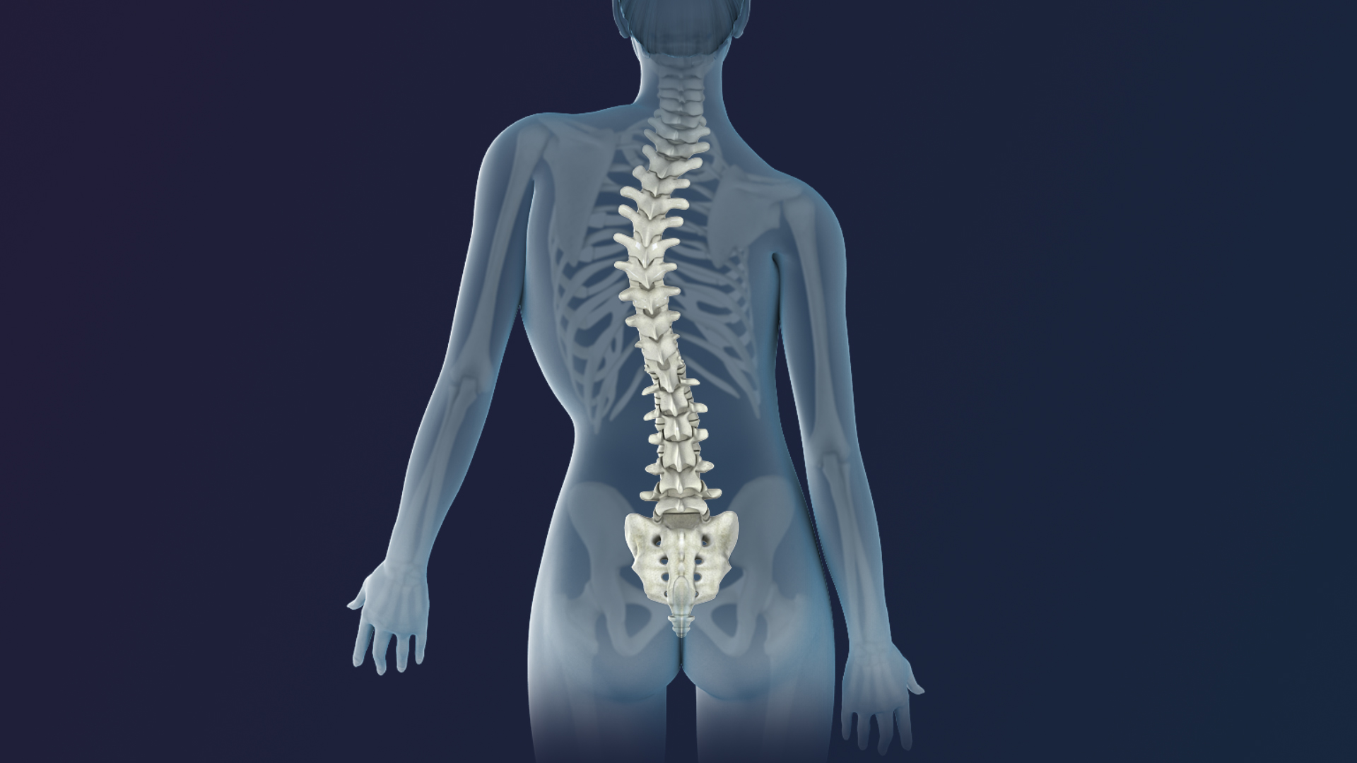 3D_Medical_Animation_scoliosis_Intervertibral_Disc